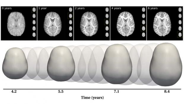 imaging of brain over time that shows increase in size and changes in structure