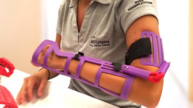 A purple plastic arm brace made with 3D printing on a person's arm.