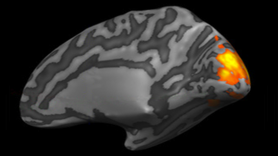MRI brain scan with hindbrain highlighted.